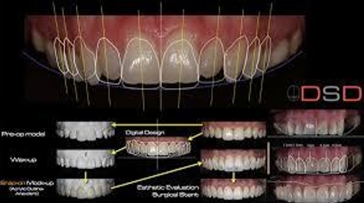 What is Digtal Smile Design? Is it for me?