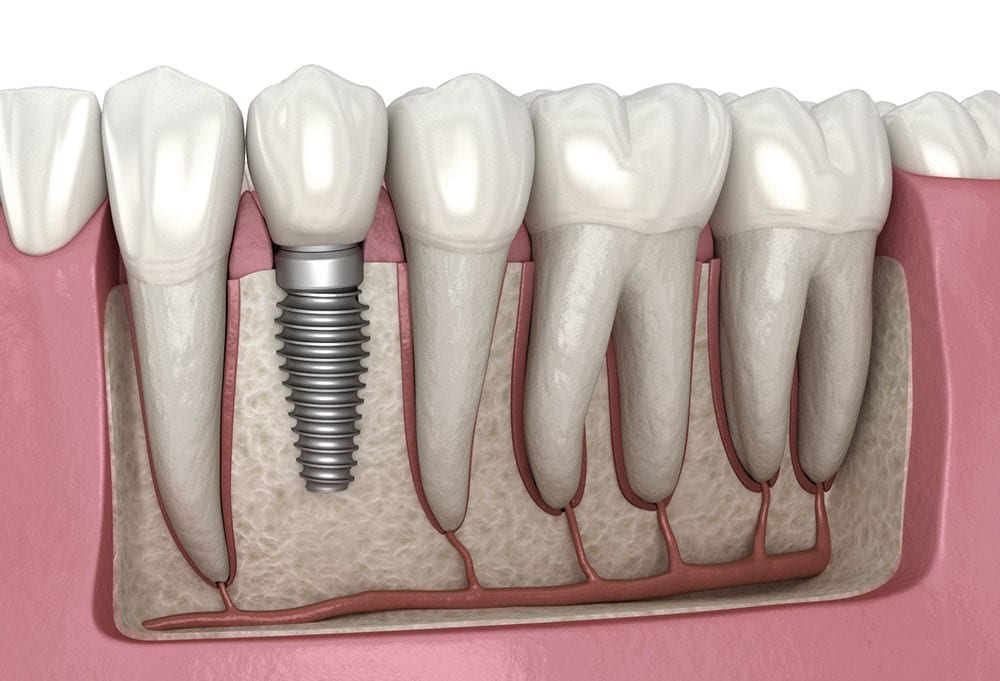 Titanium Dental Implants – All You Need To Know