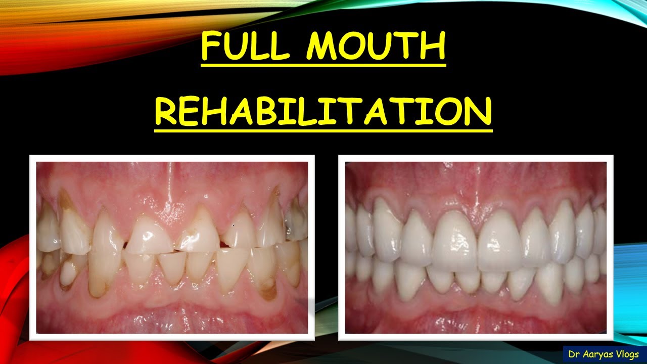 Full Mouth Rehabilitation: All You Need To Know About It