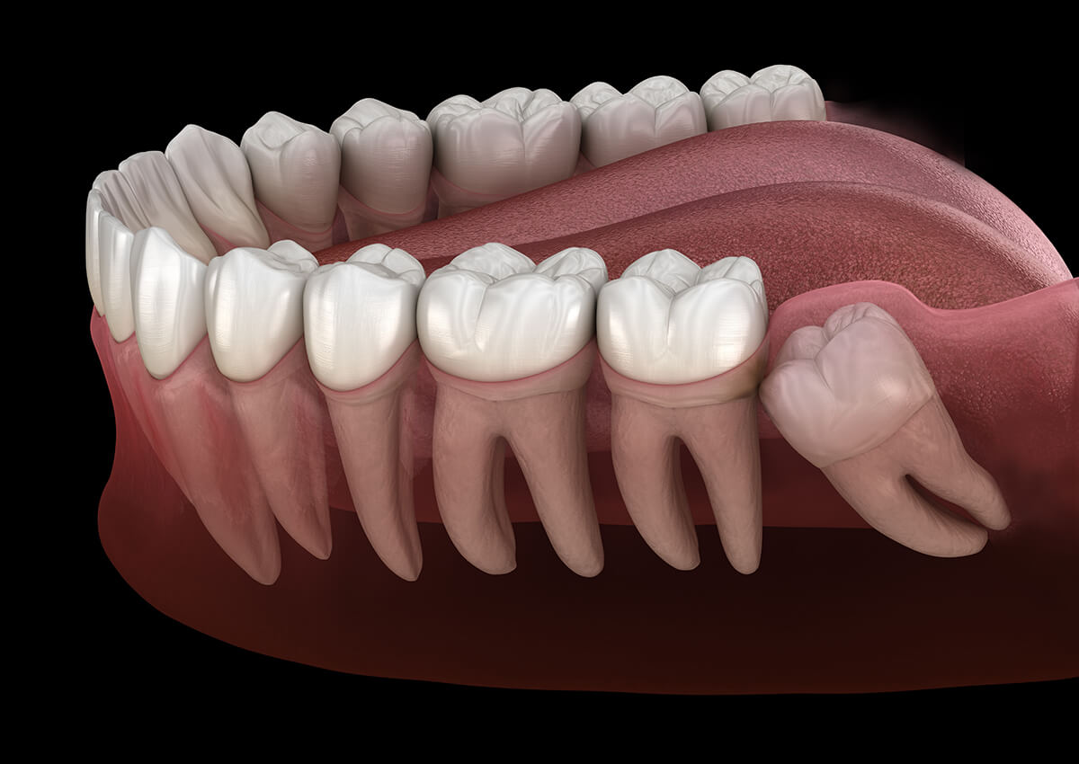 Is it Important to Get Your Wisdom Tooth Extracted?