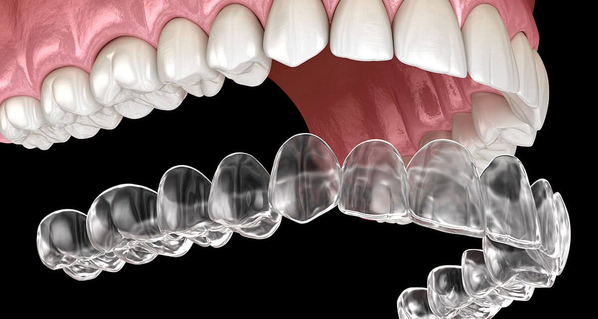 The Invisible Solution – A Comprehensive Guide to Dental Aligners
