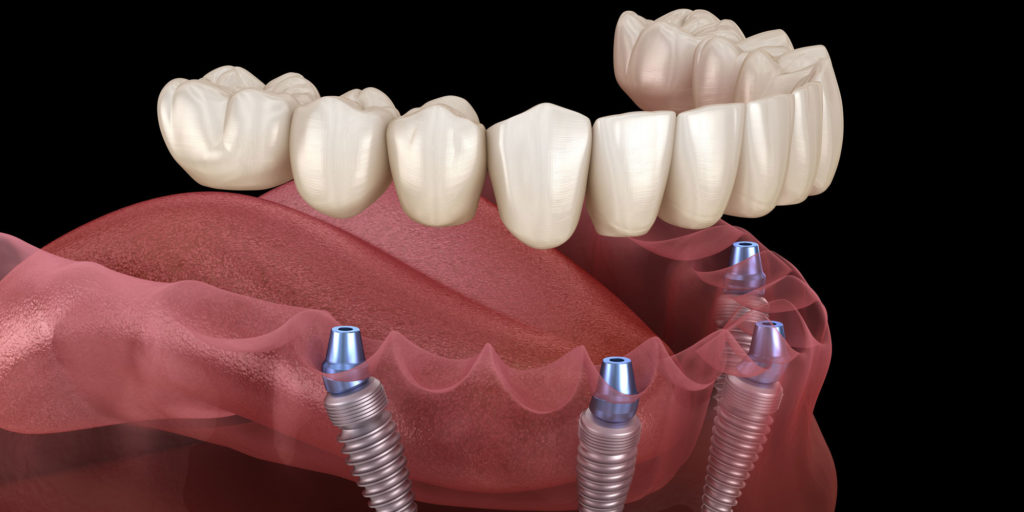 What Are Same Day Dental Implants and Are They Right for You? 